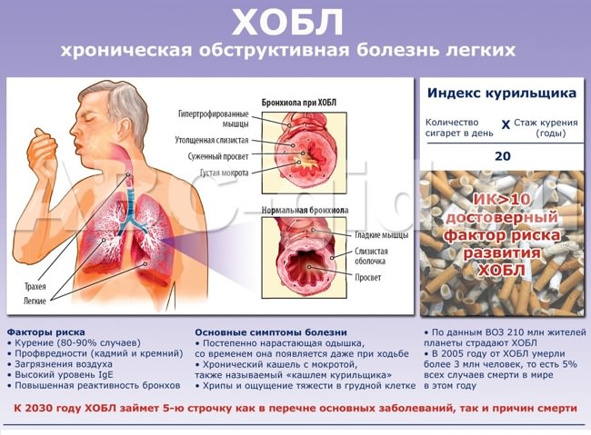 Хроническая обструктивная болезнь легких Хроническая обструктивная болезнь легких