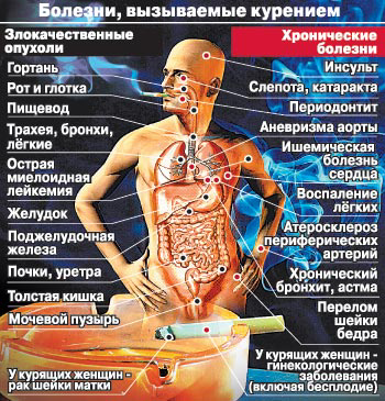 Болезни вызываемые курением Болезни вызываемые курением