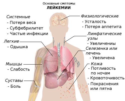 Основные симптомы рака крови Основные симптомы рака крови
