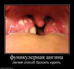 Фуникулерная ангина