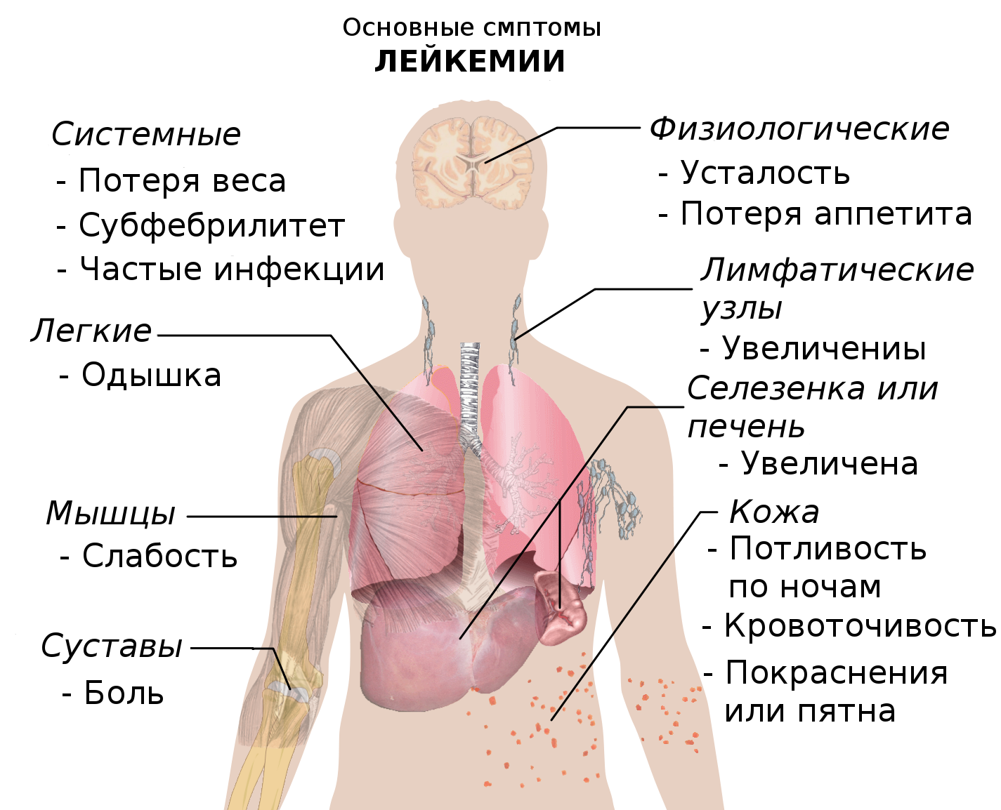Основные симптомы лейкемии