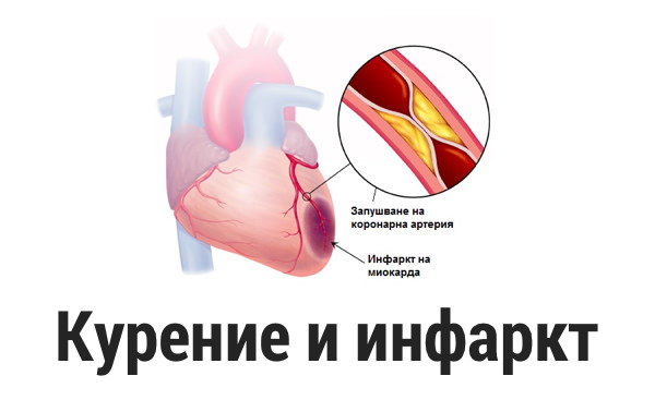 Курение и инфаркт