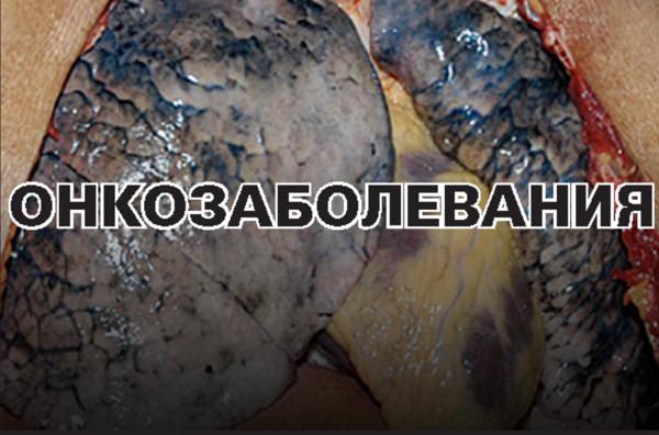 Негативные последствия курения Негативные последствия курения